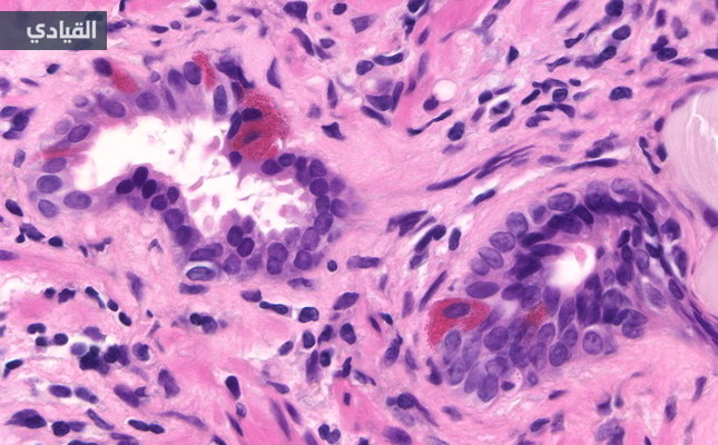 باحثون يكتشفون طريقة جديدة لعلاج سرطان البروستاتا